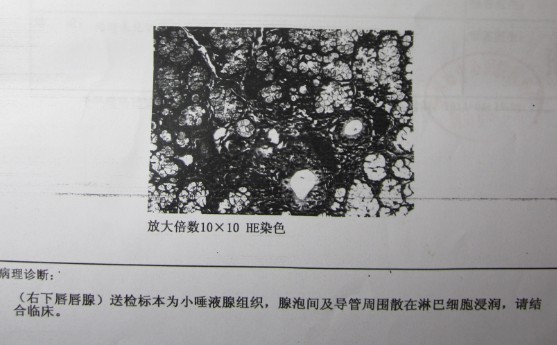 唇腺活检