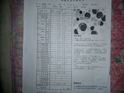 第2次骨穿