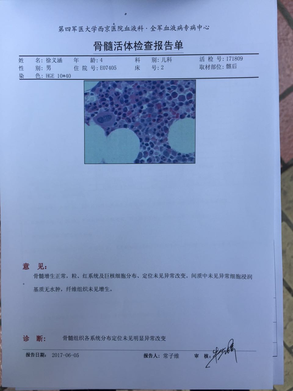 2017年5月31日骨穿活检